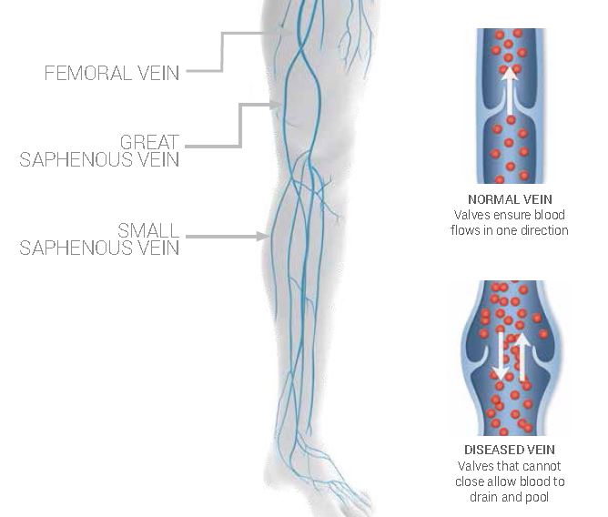Leg Vein Chart